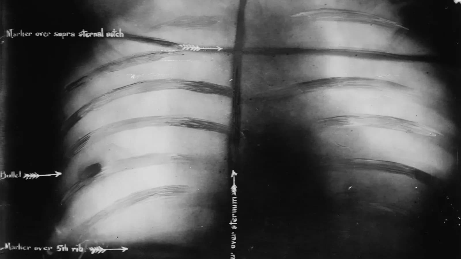 X-ray of Theodore Roosevelt's chest with an arrow labeled Bullet pointing to the slug lodged against a rib